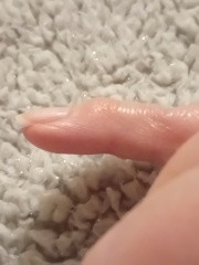 Possible arthritis in knuckles.