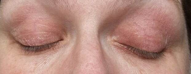 Tretinoin - burnt eyelids?