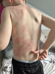 4 year old severe hives