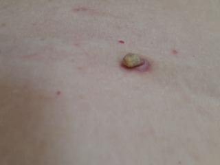 Waiting for Biopsy results cutaneous horn