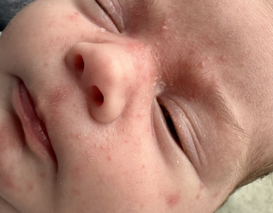 Does this look like a cmpa rash
