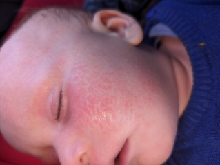 Eczema or allergic reaction?