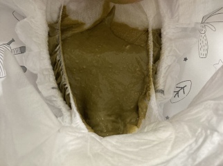 Milk allergy or colic? Warning nappy contents picture