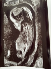 Twins after miscarriage - nub theory for fun and to calm my panic