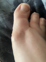 Is this gout?
