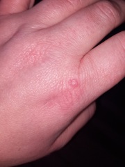 Bumps/blisters on hands