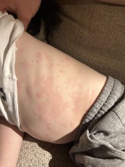 4 year old severe hives