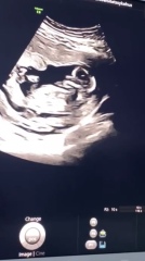 Nub guess, 12w 5d scan