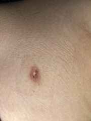 Scar not healing