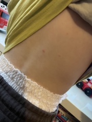 Chickenpox or something else