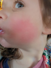 Rash photos - measles at nursery