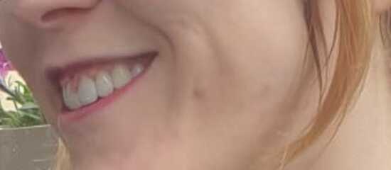 Veneers
