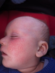 Is this an allergic reaction rash?