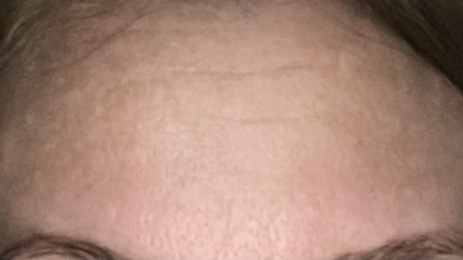 Reduce Wrinkles or Frown Lines