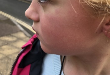 DD Allergic reaction when outside