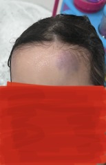 4 Year Old head bump Wednesday. Still swollen today.