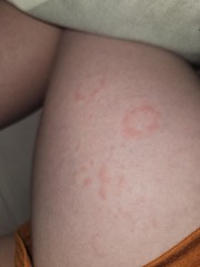 Is this ringworm?
