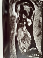 Twins after miscarriage - nub theory for fun and to calm my panic