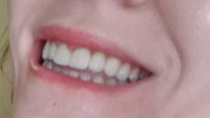 Veneers