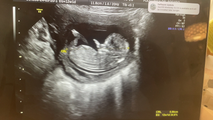 12 week scan- BOY or GIRL?! Nub theory!