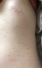 What is this rash? At my wits end!