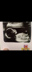 Stacked nub, 20 week scan girl?