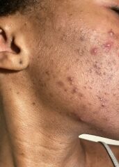 Will I ever be free from spots?!