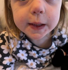 Is this chicken pox?