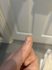 What could this dark spot on my thumbnail be?