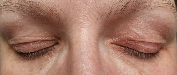 Tretinoin - burnt eyelids?