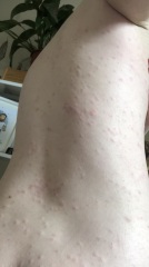 What is this rash? At my wits end!