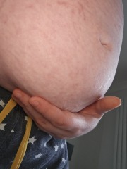 Bottom of bump is flabby and lumpy