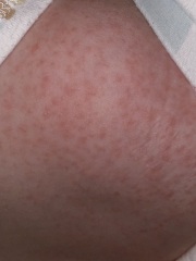 Scarlet Fever any tips?