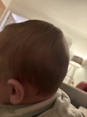 How severe is this plagiocephaly?