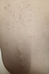 Rash on 3yr old- so many spots!