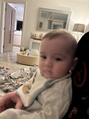 How severe is this plagiocephaly?