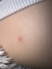 Toddler random spots