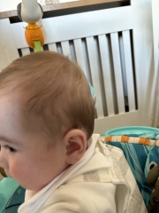Is this Plagiocephaly? Also, does plageodephaly cause brain damage/delays?