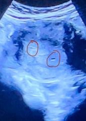 Baby due Nov 2024