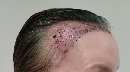 I’ve just had a hair transplant AMA