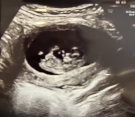 Boy or Girl?? Nub Theory