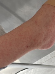 Scarlet Fever any tips?