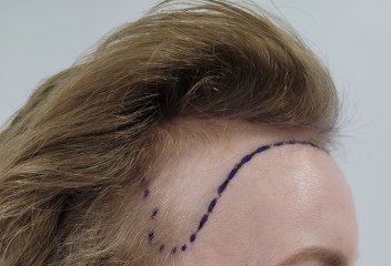 I’ve just had a hair transplant AMA