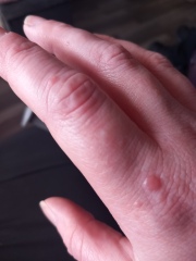 Bumps/blisters on hands