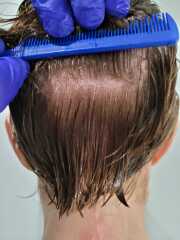 I’ve just had a hair transplant AMA