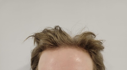 I’ve just had a hair transplant AMA