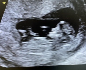 Boy or girl? Nub theory?