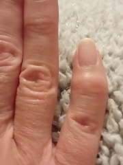 Possible arthritis in knuckles.