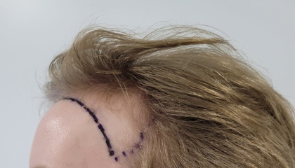 I’ve just had a hair transplant AMA