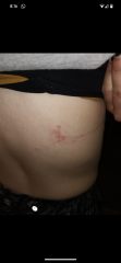 Shingles?